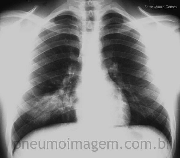 DESTAQUES DO CHEST 2015: INFECÇÕES RESPIRATÓRIAS GRAVES E NOVOS ANTIBIÓTICOS DESTAQUES DO CHEST 2015: INFECÇÕES RESPIRATÓRIAS GRAVES E NOVOS ANTIBIÓTICOS